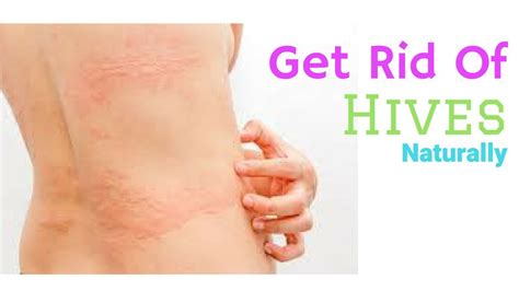 how to treat hives quickly